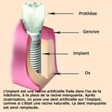 coupe d'un implant dans l'os