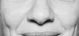 Cheeks and Nasolabial fold lines