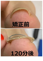 巻き爪矯正(左右の爪同時施術希望は2爪同時を購入してください)