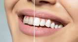 American tooth whitening
