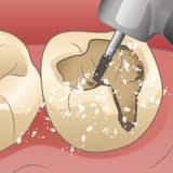 虫歯を最小限に切削するイラスト