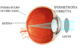 L'ipermetropia.
