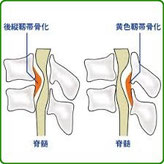 前縦靭帯骨化症や黄色靭帯骨化症の骨化