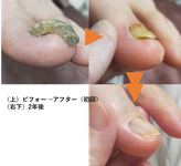 爪甲鉤彎症ケア　重複爪ケア