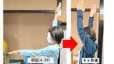 五十肩の患者様の実際の施術例