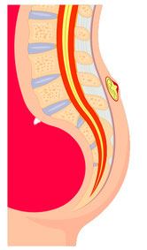 Lage des Sinus Pilonidalis im Querschnitt