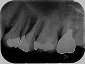 完全歯根破折歯の保存