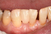 下顎前歯へのダイレクトブリッジの治療方法