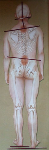 Beckenschiefstand Beinlängendifferenz