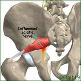 梨状筋が坐骨神経を圧迫