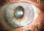 maladie glaucome