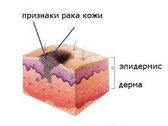 Признаки заболевания