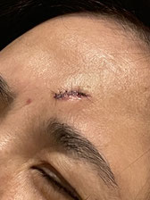 縫合された眉間の3cm程の傷。