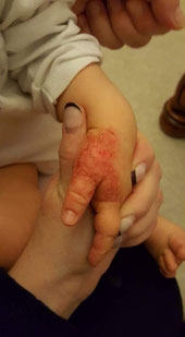 Eczéma du pouce d'un bébé