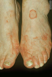 champignon des pieds