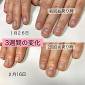 春ネイル　　キラキラ　大人可愛い　　定額松山市ネイル