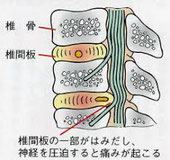 ヘルニアが飛び出していても痛みの直接の原因かは分からないのです