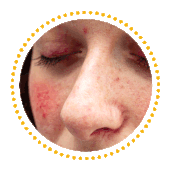 Rosacea Juckreiz