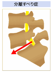 腰椎分離すべり症絵図