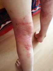 eczema infecte