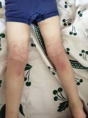 eczema infecte