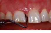 Zahnfleischprobleme Zahnfleischentzündung