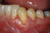 Zahnfleischabdeckung Zahnhals frei