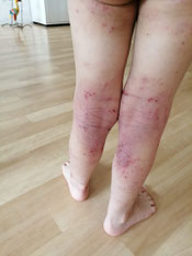 eczema infecte