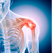 Frozen Shoulder, Impingement-Syndrom und Kalkschulter