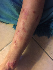 eczema lichenifie