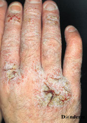 eczéma chronique des mains avec fissures