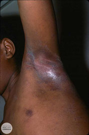 Eczéma sur peau noire du pli axillaire de couleur violette
