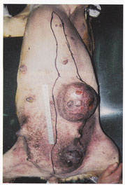 乳腺腫瘍（乳がん）の症例