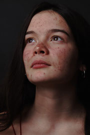 eczema et acne