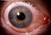 Rotes Auge? Bitte zum Augenarzt!   Bild: www.augeninfo.de