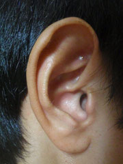 耳の粒鍼で満腹中枢を刺激!