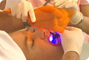 Zähne bleichen behandlung | SOS Zahnärzte