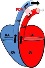 Offener PDA mit Links-Rechts-Fluss; RA: rechtes Atrium; RV: rechter Ventrikel; Pu: Pulmonalarterie; LA: linkes Atrium; LV: linker Ventrikel; Ao: Aorta