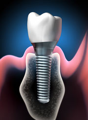 Implantat: Schraubenförmige Wurzel im Kiefer (unten) mit aufgesetzter Krone (oben) (© psdesign1 - Fotolia.com)