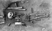 The skeleton of the earliest known case of Down syndrome is offering clues about how ancient communities looked at those with the chromosomal disorder, researchers say. (International Journal of Paleopathology)