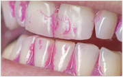 Anfärben von Zahnbelag zur Putzkontrolle (© proDente e.V.)