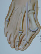 Hallux Valgus, Schemazeichnung
