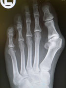 Rö.BIld: Hallux Valgus und Arthrose