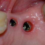 Implantes Nobel Biocare para premolar y molar superior