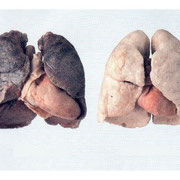 A la izquierda pulmones afectados por la EPOC. Derecha pulmones normales.