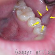 左歯にあたった頬の粘膜にできた粘液嚢腫