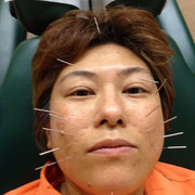 美顔鍼施術中
