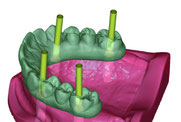 トーシンデンタル　ジルコンザーン　CAD/CAM　ソフトウェア