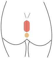 Ausschneidung einer Steissbeinfistel (Sinus pilonidalis)