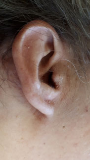 photo de dermite seborrheique de l oreille